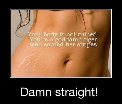 Stretch marks