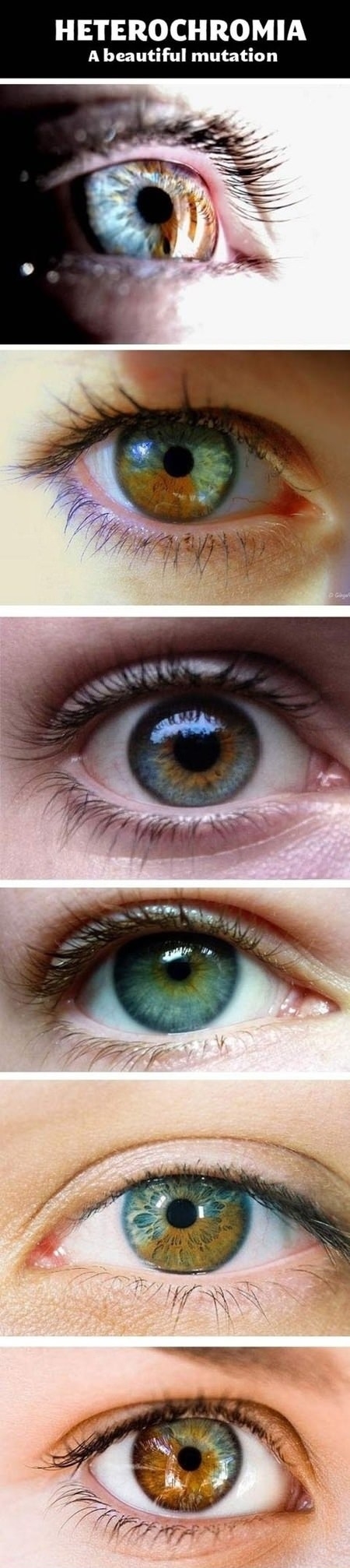 Heterochromia