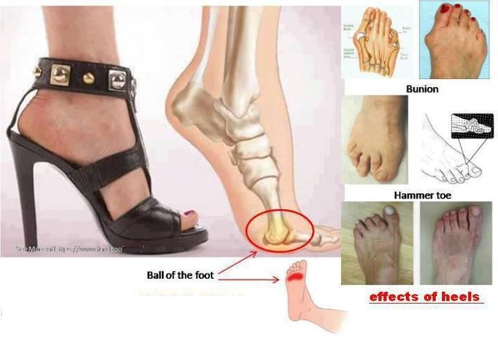 Effects of wearing heels