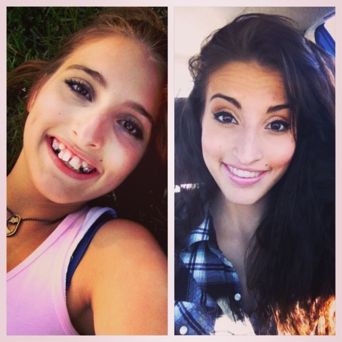 3 yrs & 3 jaw surgeries