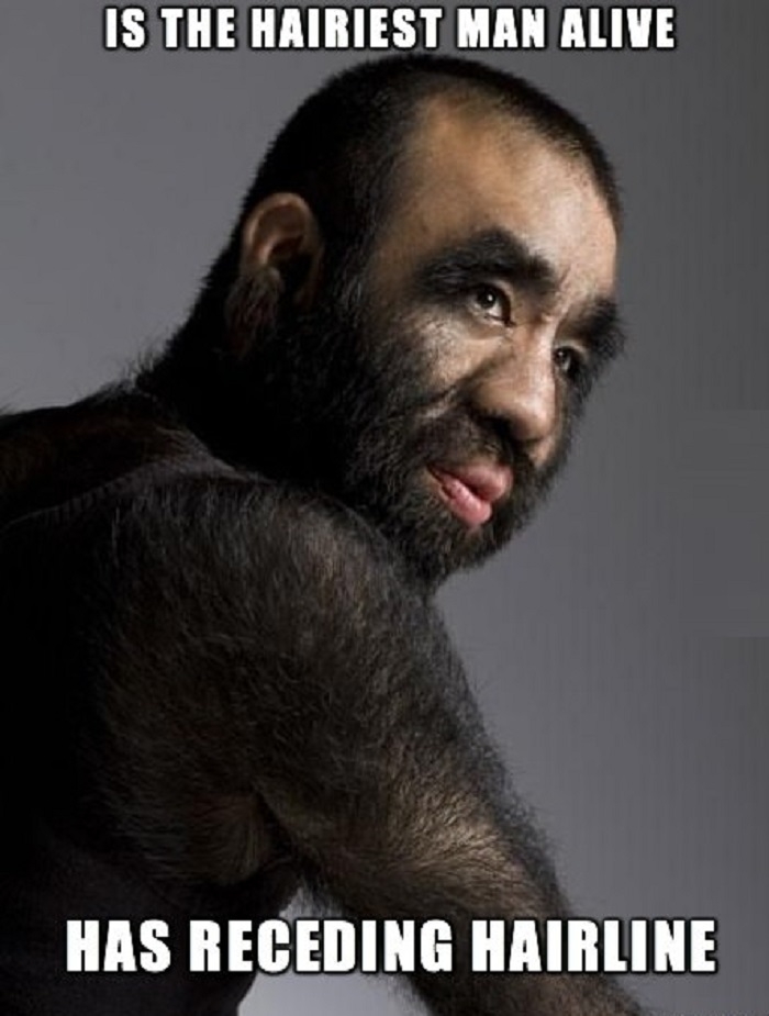 Bad luck 'hairiest man alive'