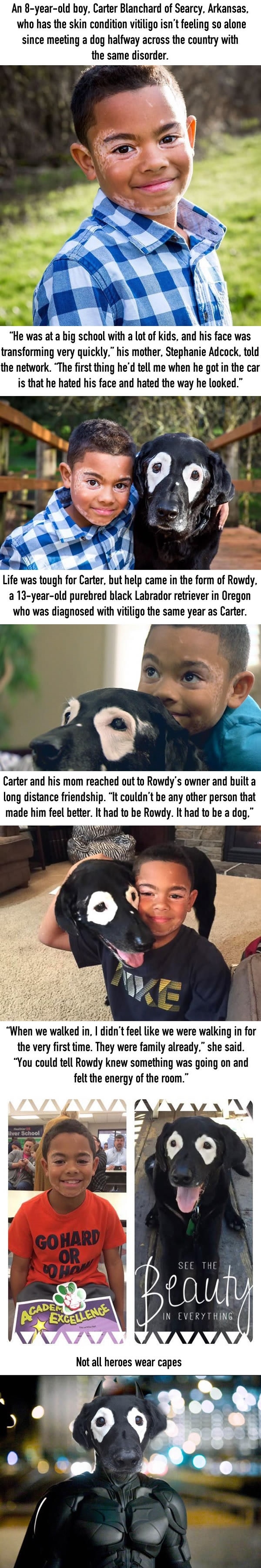 Boy with vitiligo hated himself until..