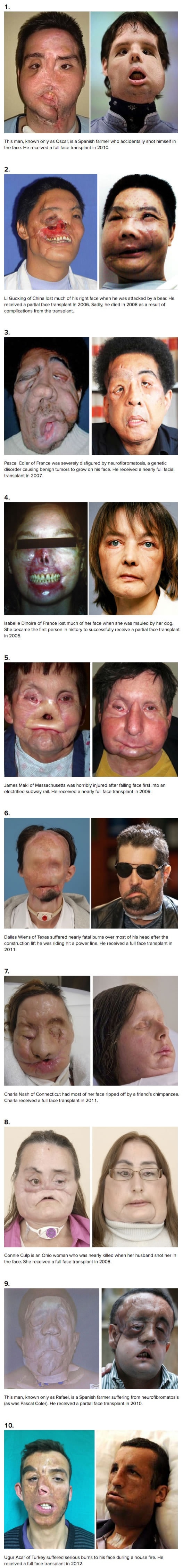 [Warning Graphic] Before & after face transplant