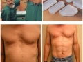 Plastic Surgery Sixpack