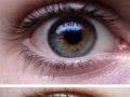 Heterochromia