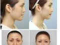 Korean plastic surgery