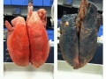 Non-smoker & smoker lungs