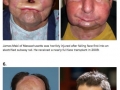 [Warning Graphic] Before & after face transplant