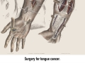 Surgery horror in the Victorian era
